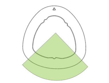 Comparativement aux matériels concurrents, le filtre triangulaire DFE se caractérise par une surface de support filtrant plus importante dans la partie basse de la cartouche.